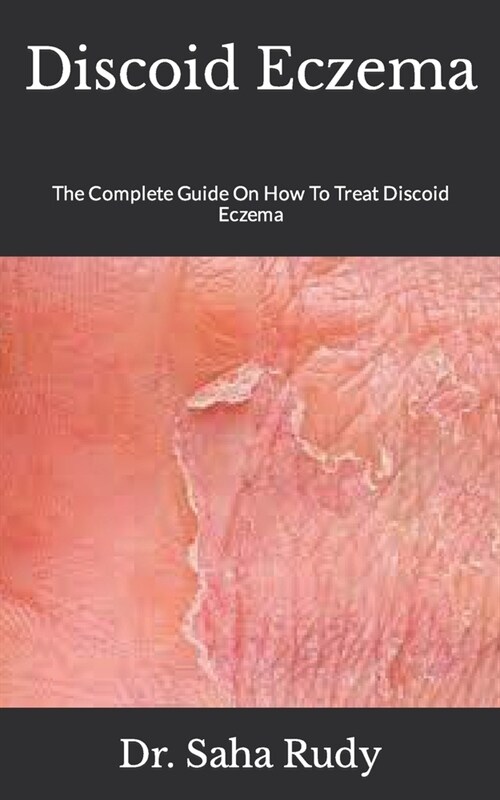 Discoid Eczema: The Complete Guide On How To Treat Discoid Eczema (Paperback)