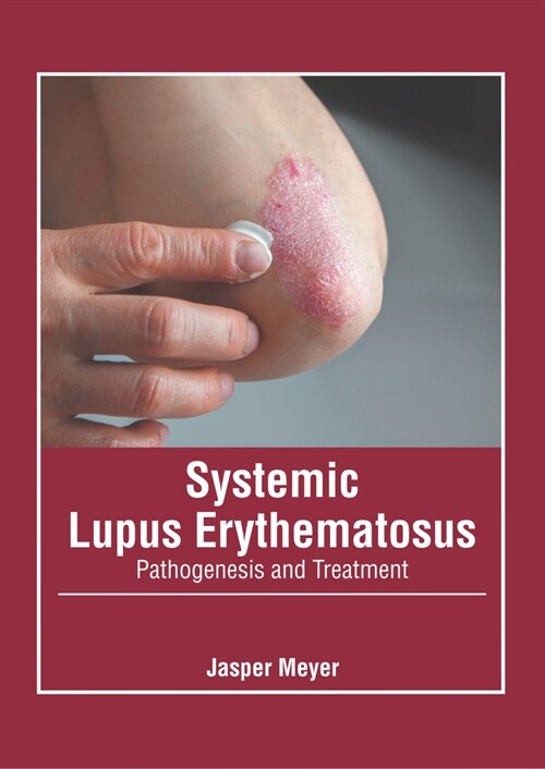 Systemic Lupus Erythematosus: Pathogenesis and Treatment (Hardcover)