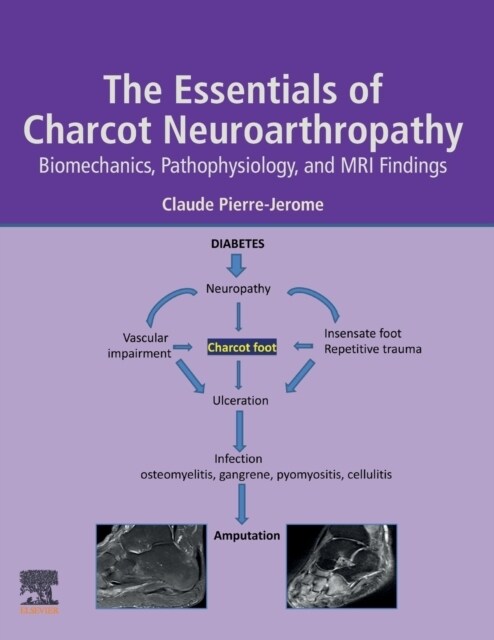 The Essentials of Charcot Neuroarthropathy: Biomechanics, Pathophysiology, and MRI Findings (Paperback)