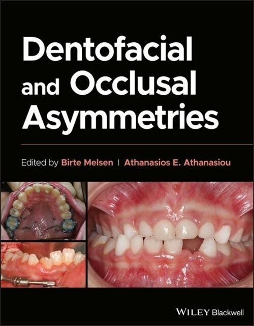 Dentofacial and Occlusal Asymmetries (Hardcover, 1st)