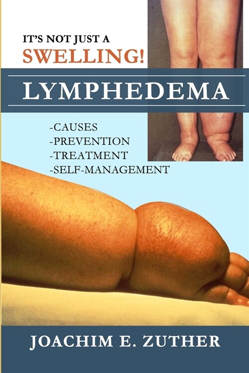 Its Not Just a Swelling! Lymphedema: Causes, Prevention, Treatment, Self-Management (Paperback)