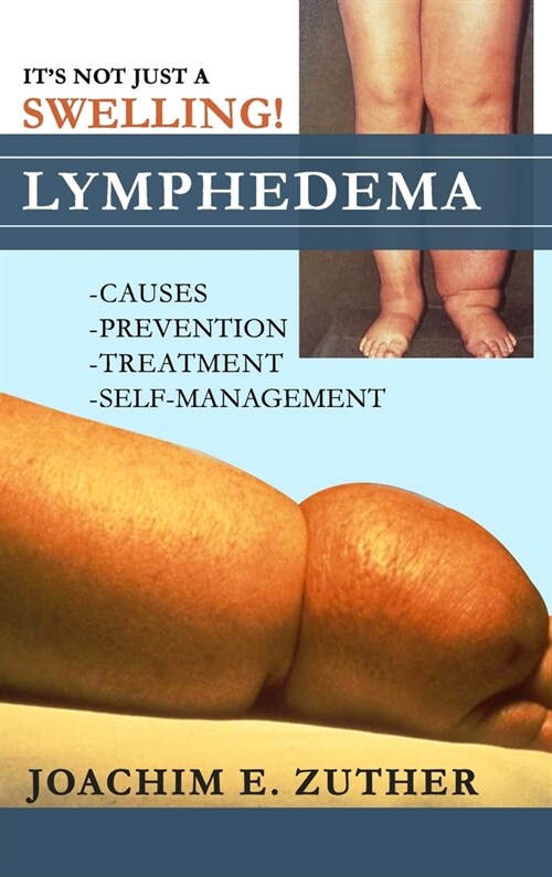 Its Not Just a Swelling! Lymphedema: Causes, Prevention, Treatment, Self-Management (Hardcover)