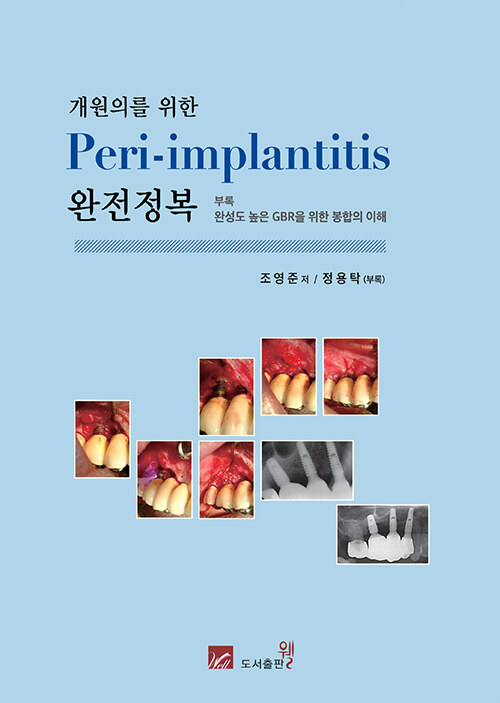 개원의를 위한 Peri-implantitis 완전정복