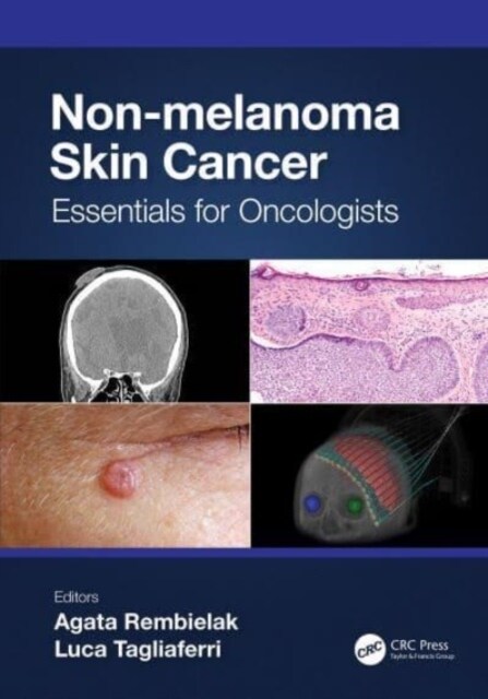 Non-melanoma Skin Cancer : Essentials for Oncologists (Hardcover)