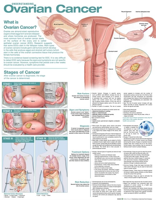 Understanding Ovarian Cancer Anatomical Chart (Wallchart, 2 ed)