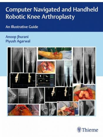 Computer Navigated and Handheld Robotic Knee Arthroplasty: An Illustrative Guide (Hardcover)