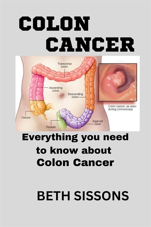 Colon Cancer: Everything you need to know about colon cancer (Paperback)