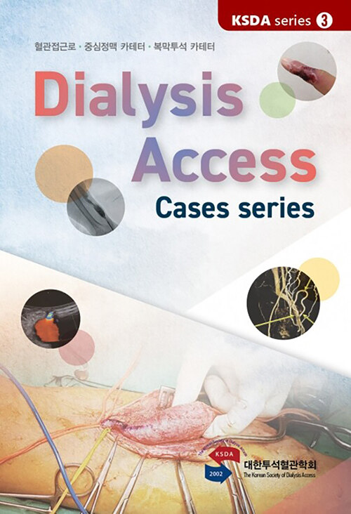 Dialysis Access : Case series