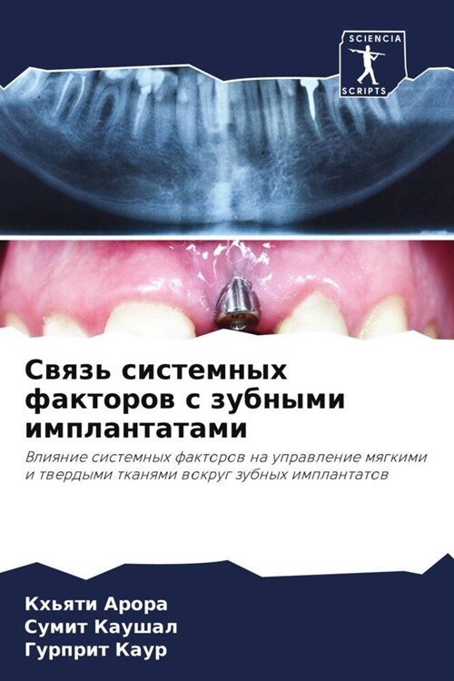 Swqz sistemnyh faktorow s zubnymi implantatami (Paperback)