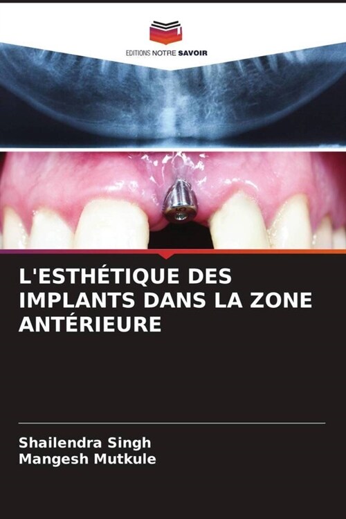 LESTHETIQUE DES IMPLANTS DANS LA ZONE ANTERIEURE (Paperback)