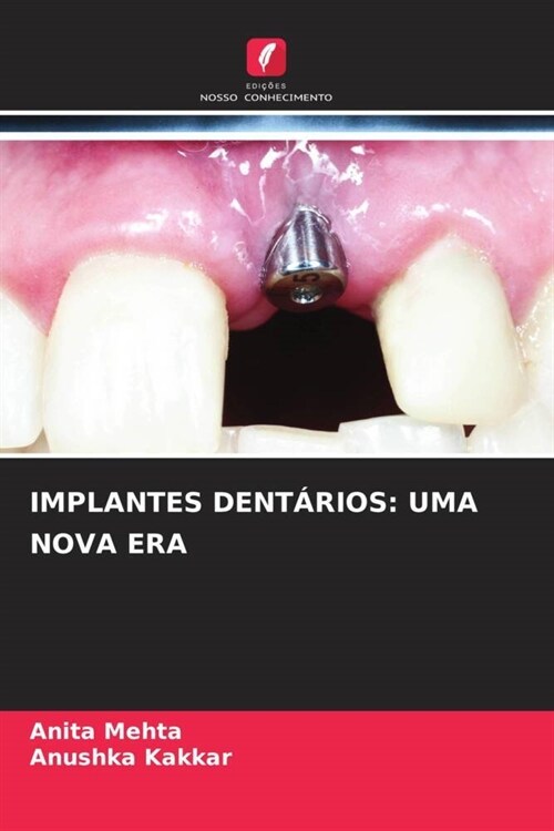 IMPLANTES DENTARIOS: UMA NOVA ERA (Paperback)