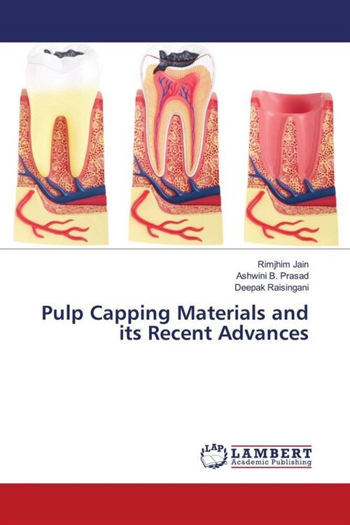 Pulp Capping Materials and its Recent Advances (Paperback)