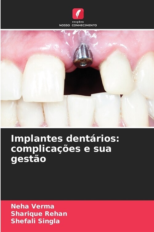 Implantes dent?ios: complica寤es e sua gest? (Paperback)