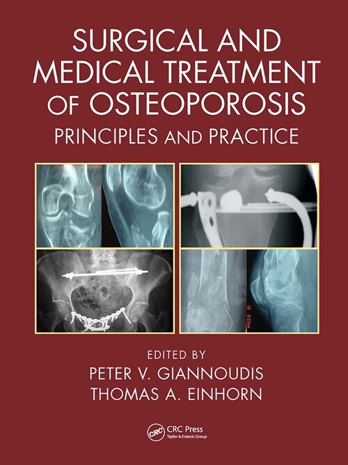 Surgical and Medical Treatment of Osteoporosis : Principles and Practice (Paperback)