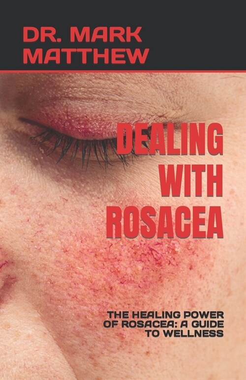 Dealing with Rosacea: The Healing Power of Rosacea: A Guide to Wellness (Paperback)