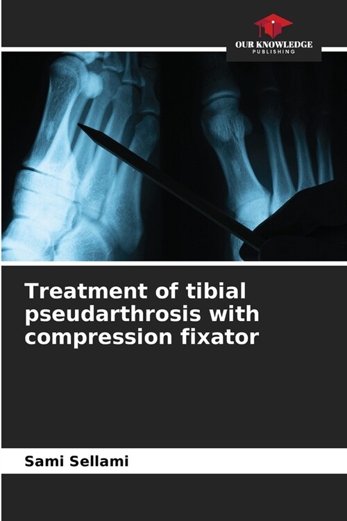 Treatment of tibial pseudarthrosis with compression fixator (Paperback)