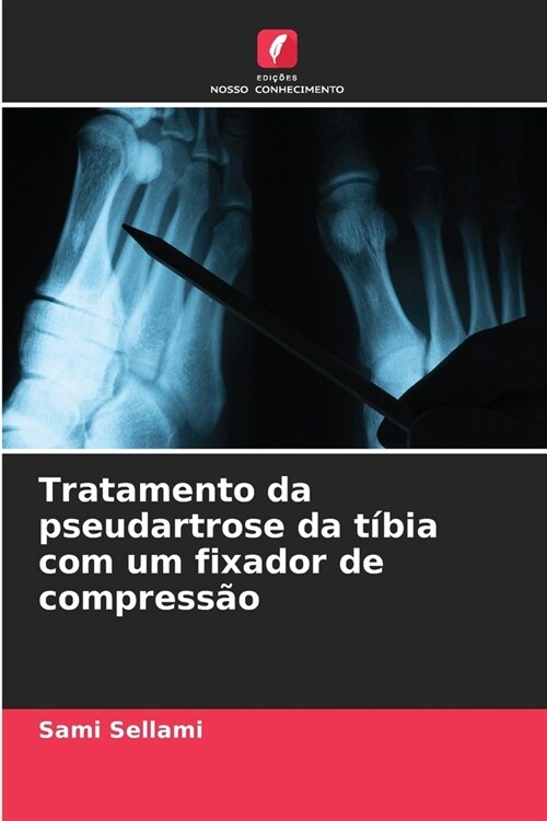 Tratamento da pseudartrose da t?ia com um fixador de compress? (Paperback)