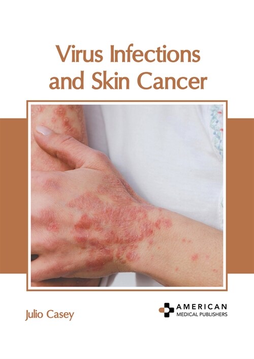 Virus Infections and Skin Cancer (Hardcover)