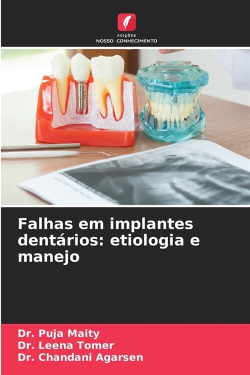 Falhas em implantes dent?ios: etiologia e manejo (Paperback)