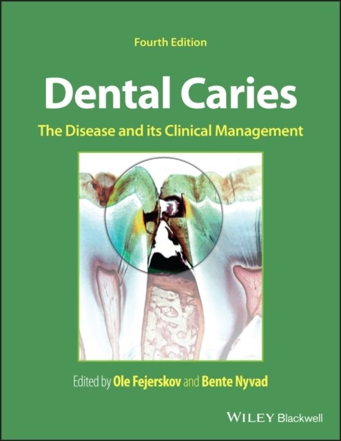 Dental Caries: The Disease and Its Clinical Management (Hardcover, 4)