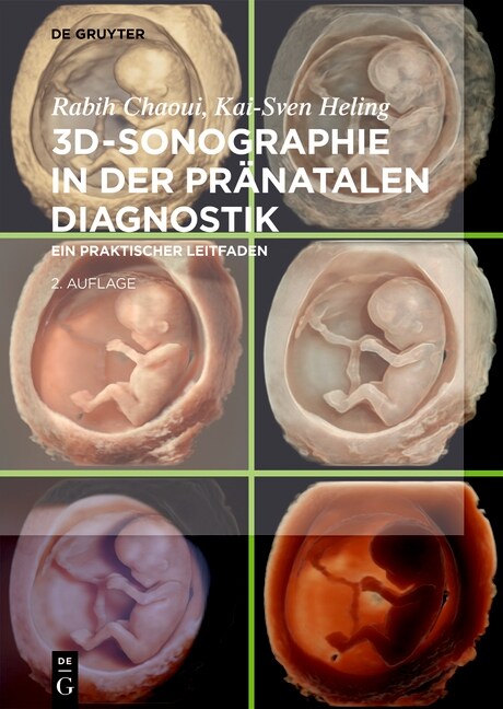 3d-Sonographie in Der Pr?atalen Diagnostik: Ein Praktischer Leitfaden (Hardcover, 2, 2.Erweiterte Un)