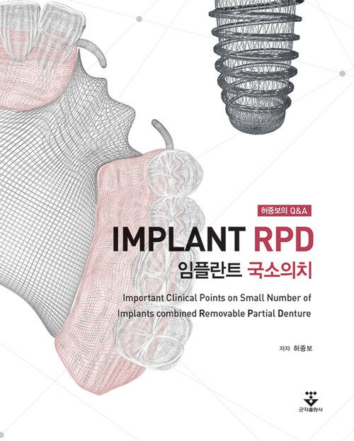 임플란트 국소의치 : 허중보의 Q&A