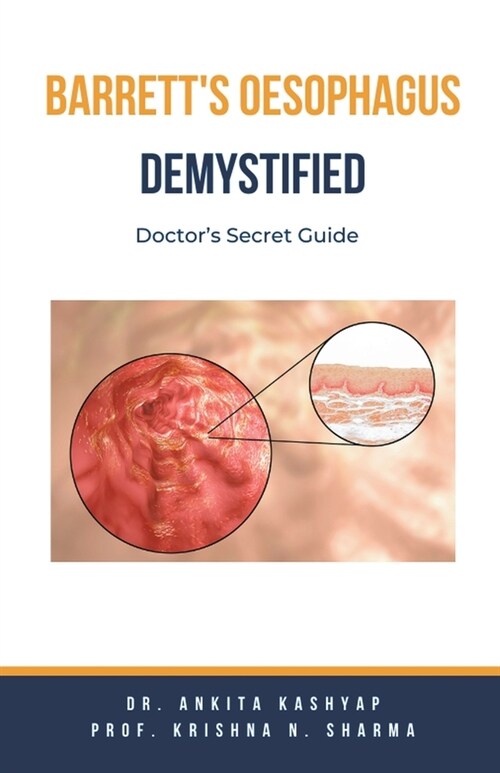 Barretts Oesophagus Demystified: Doctors Secret Guide (Paperback)