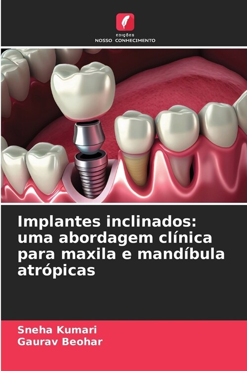 Implantes inclinados: uma abordagem cl?ica para maxila e mand?ula atr?icas (Paperback)