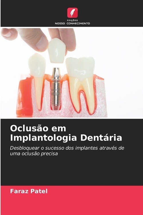 Oclus? em Implantologia Dent?ia (Paperback)