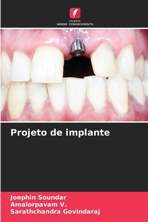 Projeto de implante (Paperback)