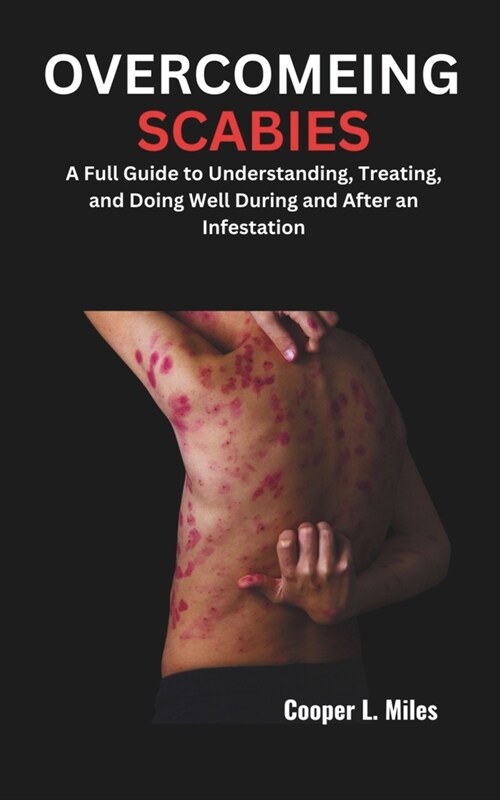 Overcomeing Scabies: A Full Guide to Understanding, Treating, and Doing Well During and After an Infestation (Paperback)