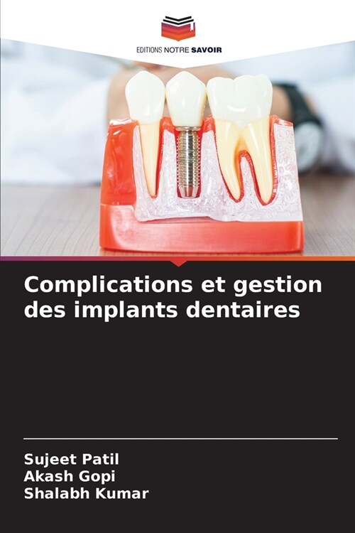 Complications et gestion des implants dentaires (Paperback)