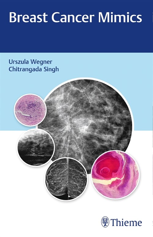 Breast Cancer Mimics (eBook Code, 1st)