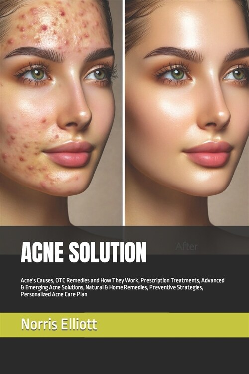 Acne Solution: Acnes Causes, OTC Remedies and How They Work, Prescription Treatments, Advanced & Emerging Acne Solutions, Natural & (Paperback)