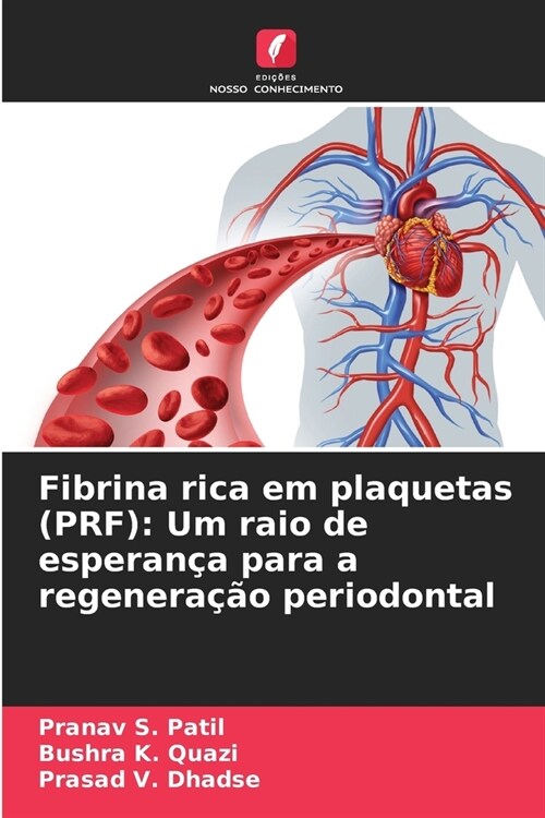 Fibrina rica em plaquetas (PRF): Um raio de esperan? para a regenera豫o periodontal (Paperback)