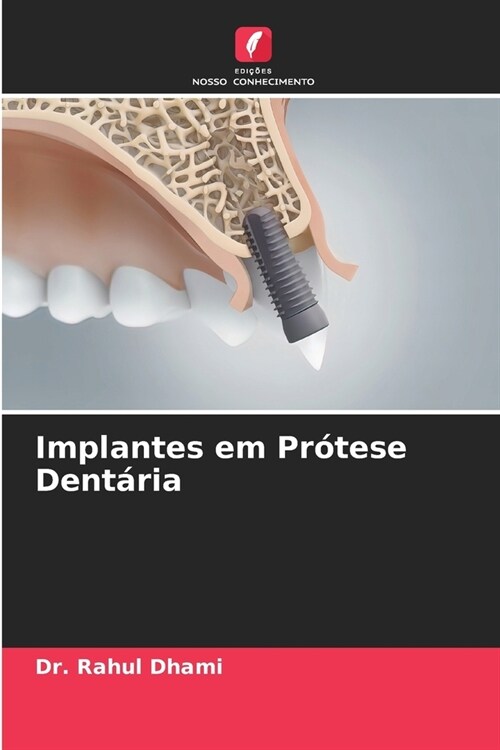 Implantes em Pr?ese Dent?ia (Paperback)