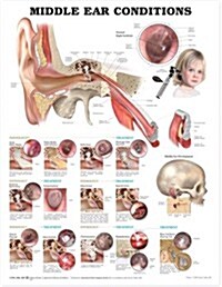 Middle Ear Conditions Anatomical Chart (Other, 2)