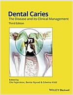 Dental Caries: The Disease and Its Clinical Management (Hardcover, 3, Revised)
