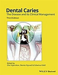 Dental Caries, Third Edition (Hardcover, 3, Revised)