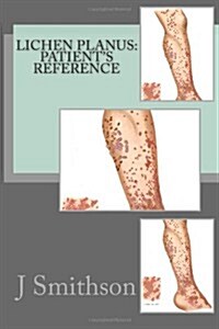 Lichen Planus: Patients Reference (Paperback)