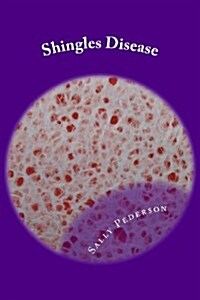 Shingles Disease: The Complete Guide (Paperback)