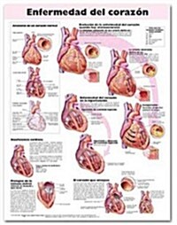 Heart Disease Anatomical Chart in Spanish (Enfermedad del Corazon) (Hardcover)