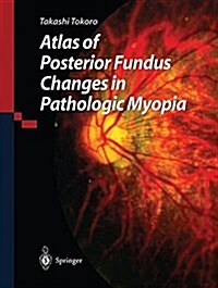 Atlas of Posterior Fundus Changes in Pathologic Myopia (Paperback)