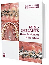 Mini-implants (Hardcover)