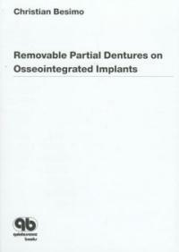 Removable partial dentures on osseointegrated implants : principles of treatment planning and prosthetic rehabilitation in edentulous mandible