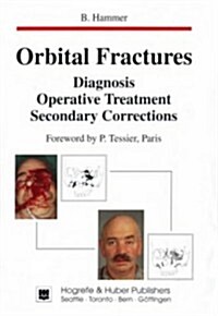 Orbital Fractures (Hardcover)