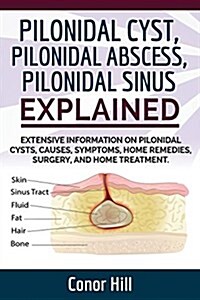Pilonidal Cyst Fast Healing Guide. Fast Track Guide to Pilonidal Cyst Relief by Understanding the Pilonidal Sinus, Abscess, Causes, Symptoms, and Appl (Paperback)