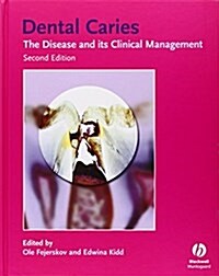 Dental Caries: The Disease and Its Clinical Management (Hardcover, 2nd)