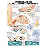 Understanding Carpal Tunnel Syndrome Anatomical Chart (Chart, 1st, Wall)