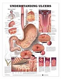 Understanding Ulcers Anatomical Chart (Other)